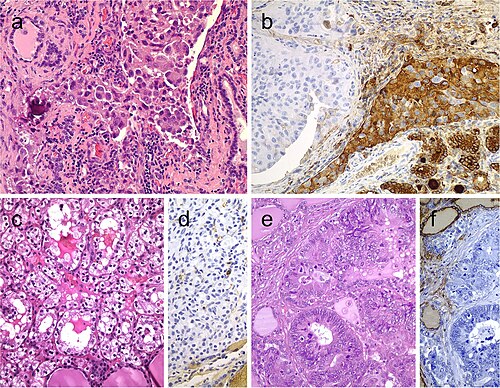 Metastatic carcinomas in the thyroid gland. Thyroid metastasis from lung adenocarcinoma (a, b). Some metastatic tumor cells (right) are positive for thyroglobulin due to diffusion artifact and should not be overinterpreted as positive (b). Metastatic clear cell renal carcinoma (c), metastatic renal cells are negative for thyroglobulin (d). Colonic adenocarcinoma metastatic to the thyroid gland (e); the thyroid tissue is positive for thyroglobulin while the metastatic adenocarcinoma is negative (f)[9]
