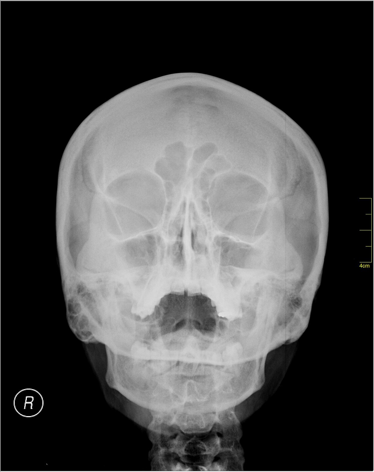 Medical X-Ray imaging PZJ06 nevit.jpg