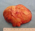 The resected lipoma (8 cm × 6 cm × 3 cm)
