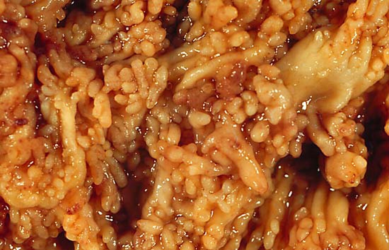 Chronic Ulcerative Colitis 1.jpg