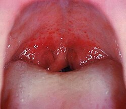 Mouth wide open showing the throat Note the petechiae, or small red spots, on the soft palate. This is an uncommon but highly specific finding in streptococcal pharyngitis.[13]