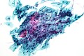Candida organisms on a pap test