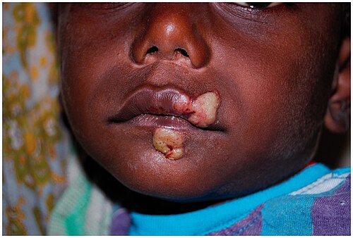 Papilloma mother yaw