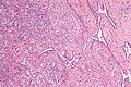 Micrograph of the rete testis involved by seminoma. H&E stain.