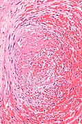 Micrograph showing a thrombus (center of image) within a blood vessel of the placenta. H&E stain.