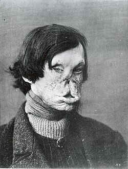 Face severely deformed by leprosy