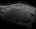 Fig. 6 Ultrasonography of a liposarcoma mimicking a lipoma. This homogeneous high-echoic mass has the same appearance as a lipoma.[69]