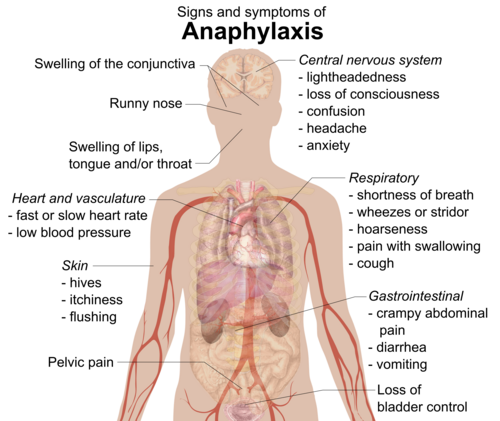 Signs and symptoms of anaphylaxis