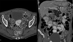 Phosphate binders in the colon, visible in computed tomography as multiple small radiopaque foreign bodies.