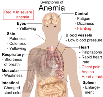 Chart listing symptoms of anemia and locating them to areas of the body. Eyes: yellowing. Skin: paleness, coldness, yellowing. Respiratory: shortness of breath. Muscular: weakness. Intestinal: changed stool color. Central: fatigue, dizziness; in severe cases fainting. Blood vessels: low blood pressure. Heart: palpitations, rapid heart rate; in severe cases chest pain, angina, heart attack. Spleen: enlargement.