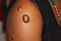Keloid nodules (1–2 cm in diameter) and a keloid tumor >2 cm in diameter