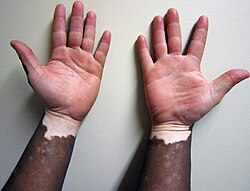 Nonsegmental vitiligo on dark skin
