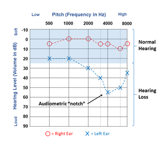 Results of a hearing test plotted on an audiogram illustrating a typical "noise notch" in the left ear