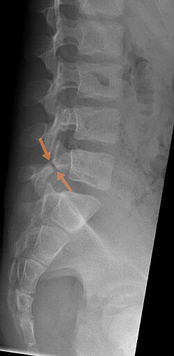 Arrows show break in pars interarticularis at L5. X-Ray of lumbar spine, lateral projection, in an 11-year-old boy