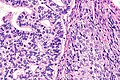 Adenosquamous carcinoma, with glandular features at left and squamous features at right