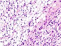 Fig. 3 Lower-power micrograph of myxoid liposarcoma tumor