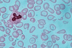 Microscopic view with Giemsa stain of a blood smear with abnormally small, pale red blood cells