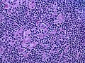 Hodgkin lymphoma, nodular lymphocyte predominant (high-power view): Notice the presence of L&H cells, also known as "popcorn cells" (H&E).