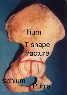 T shape fracture shown on bone model