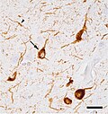 Micrograph of tauopathy (brown) in a neuronal cell body (arrow) and process (arrowhead) in the cerebral cortex of a patient with Alzheimer's disease. The scale bar=25 microns (0.025mm).