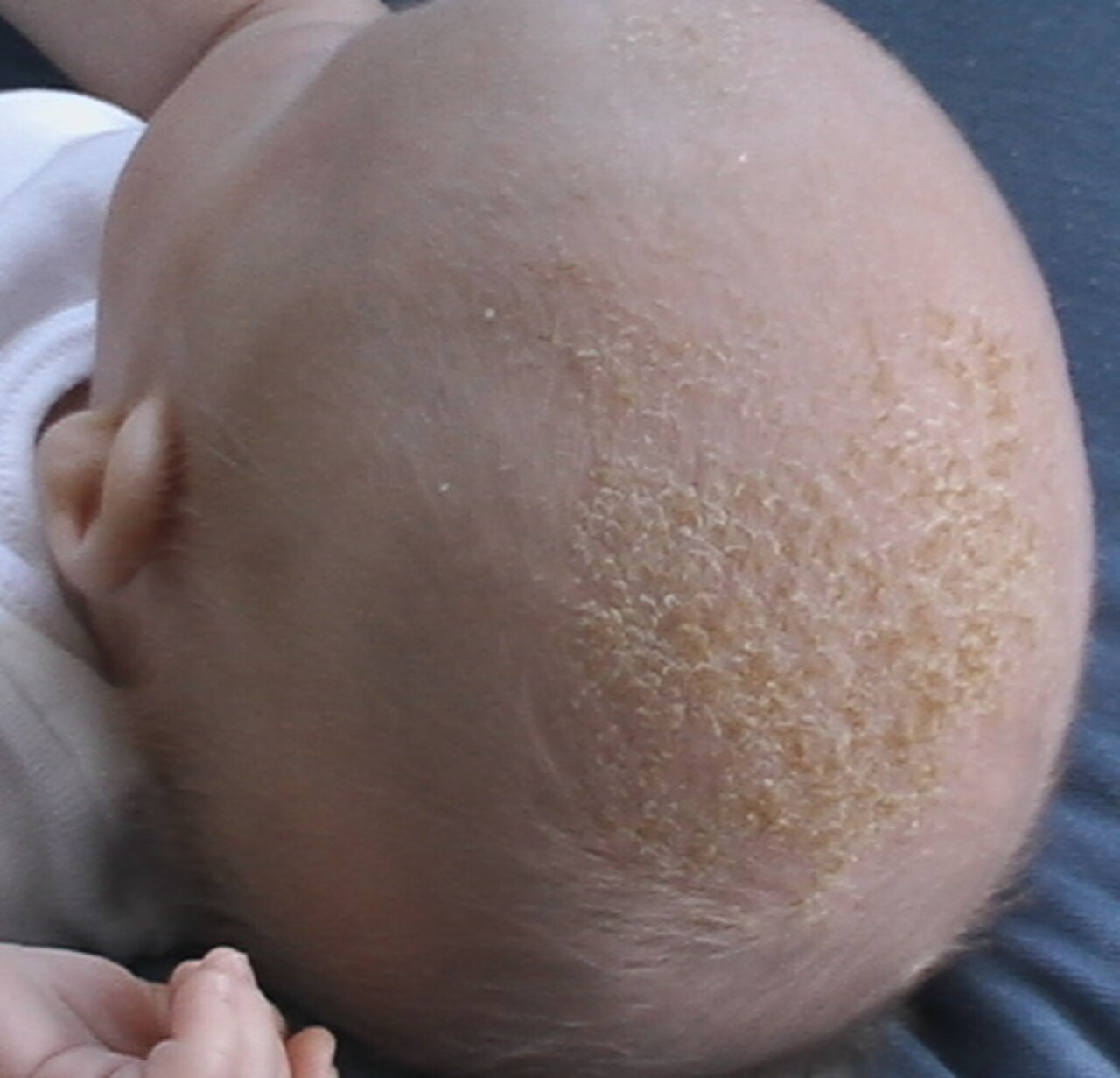 Baby With Cradle Cap.jpg