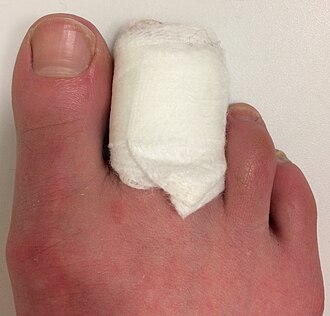 second and third toes wrapped in padding and a bandage, leaving the big toe free