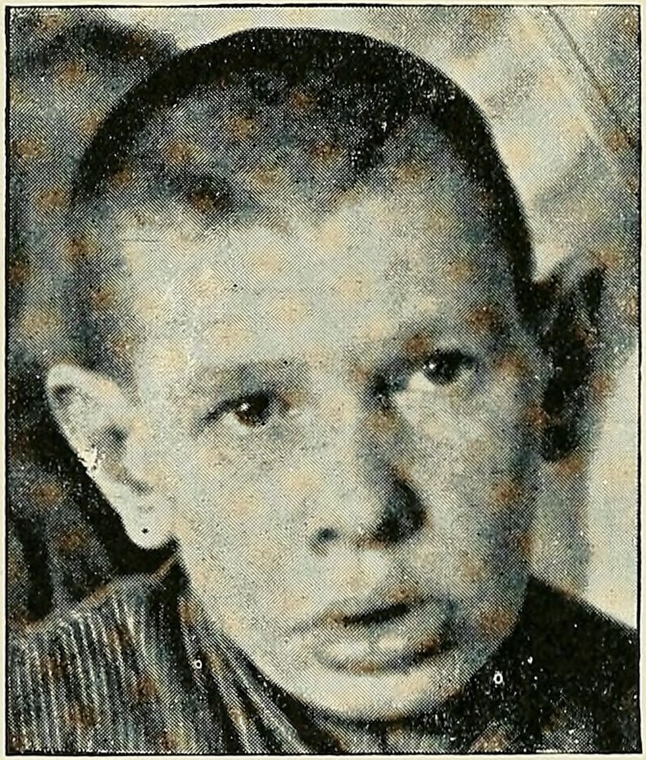 Excessive length of ears; facial asymmetry (Peterson 260).jpg