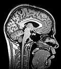 Median plane magnetic resonance imaging of the head.