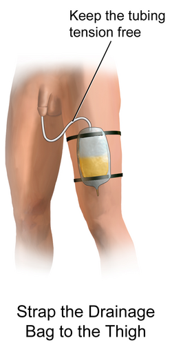 foley catheter