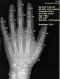 BoneXpert software for assisting physicians