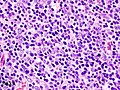 Histopathological image of thymoma type B1. Anterior mediastinal mass surgically resected. Hematoxylin & eosin stain.