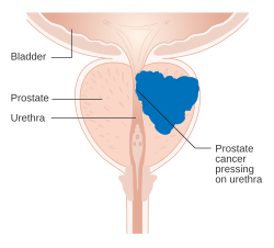 Cross-section diagram of prostate with urethra running through centrally. A large mass within the prostate compresses the urethra.