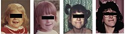 Censor bars used to anonymise a woman with familial dysautonomia