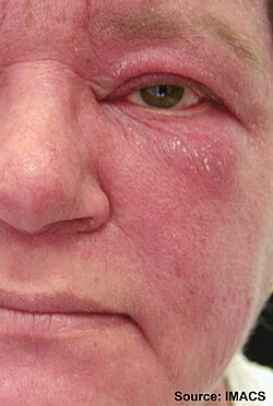 Facial rash