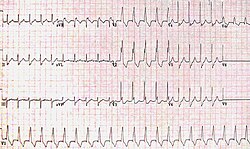 RBBB with associated tachycardia