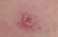 Melanoma, right posterior thigh