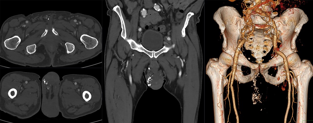 Phlebolithen in skrotaler Varicocele 69M - CT - 001.jpg