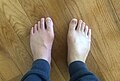 Gout in the big toe of the left foot, compared to the healthy right foot