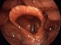 Structures of the larynx as viewed during laryngoscopy. The leaf-like epiglottis is shown as number '3'. Other structures: 1=vocal folds, 2=vestibular fold, 3=epiglottis, 4=plica aryepiglottica, 5=arytenoid cartilage, 6=sinus piriformis, 7=dorsum of the tongue.