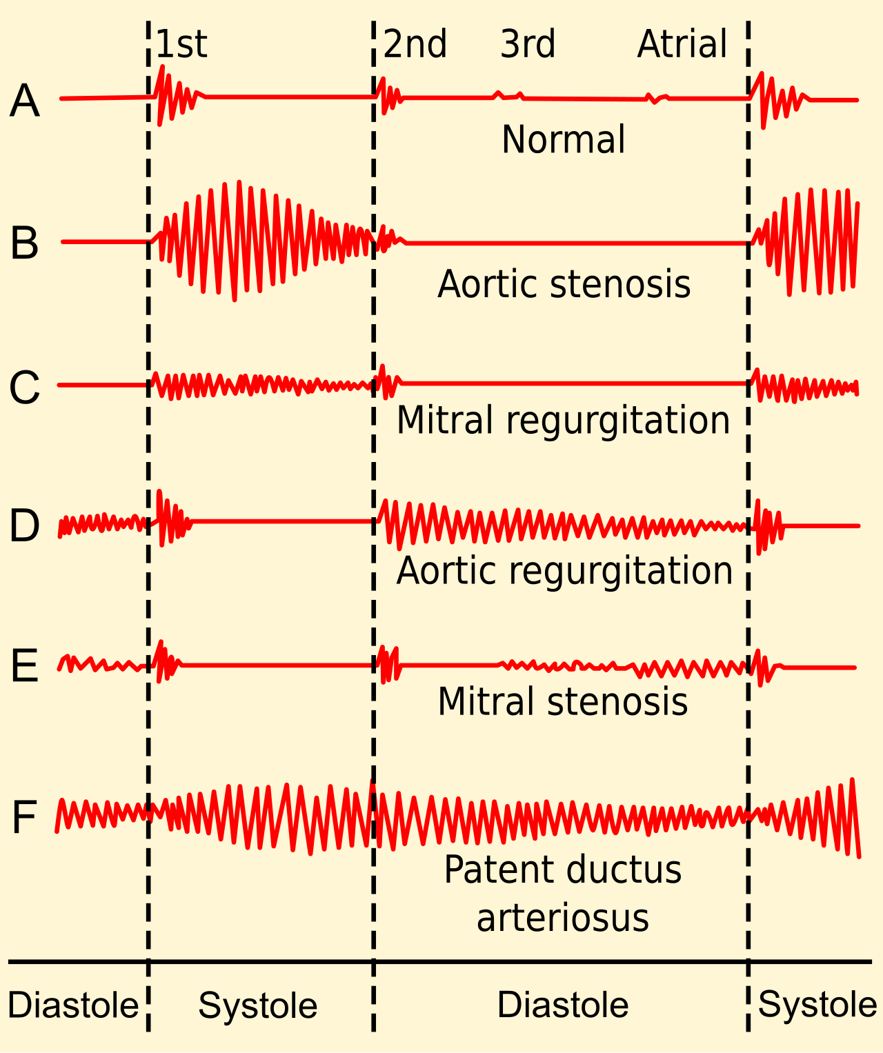 Phonocardiograms from normal and abnormal heart sounds.svg