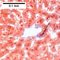 MASH (inflammation) and fibrosis stage 1
