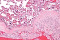 Micrograph of chronic deciduitis. H&E stain.