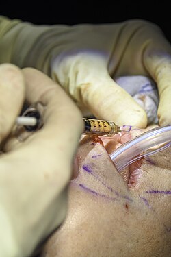 Close-up of a surgical procedure showing a gloved hand injecting fat into the area around the mouth using a small syringe, with preoperative markings visible on the skin.