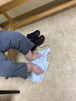 Severe edema in the legs and feet