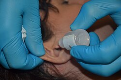 A gloved hand is holding a bottle of ear drops over an ear