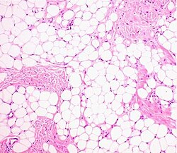 Histopathology of a lipoma: The mass is composed of lobules of mature white adipose tissue divided by fibrous septa containing thin-walled capillary-sized vessels.[25][predatory publication] H&E stain.