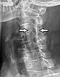 Projectional radiograph of a man presenting with pain by the nape and left shoulder, showing a stenosis of the left intervertebral foramen of cervical spinal nerve 4 due to age-related degenerative changes, corresponding with the affected dermatome