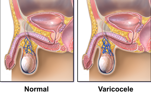 Diagram of a varicocele