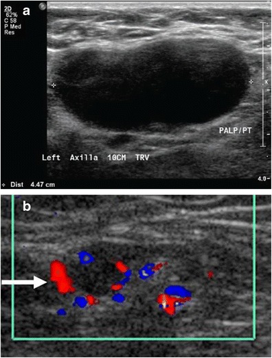Medical ultrasonography of a soft tissue lump, showing signs of a suspected malignant lymph node:[16] - Doppler ultrasonography that shows hyperaemic blood flow in the hilum and central cortex and/or abnormal (non-hilar cortical) blood flow - Increased focal cortical thickness greater than 3 mm - Absence of the fatty hilum