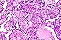 Mesothelioma